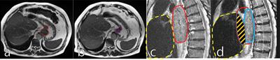 Review of MR-Guided Radiotherapy for Esophageal Cancer